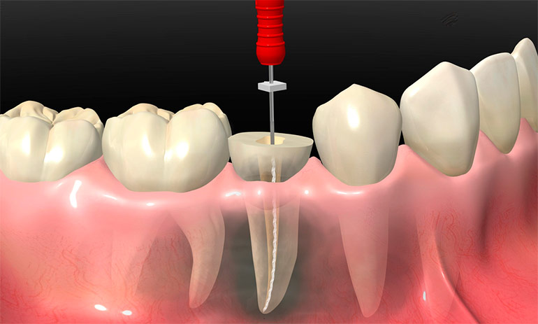Лечение пульпита 