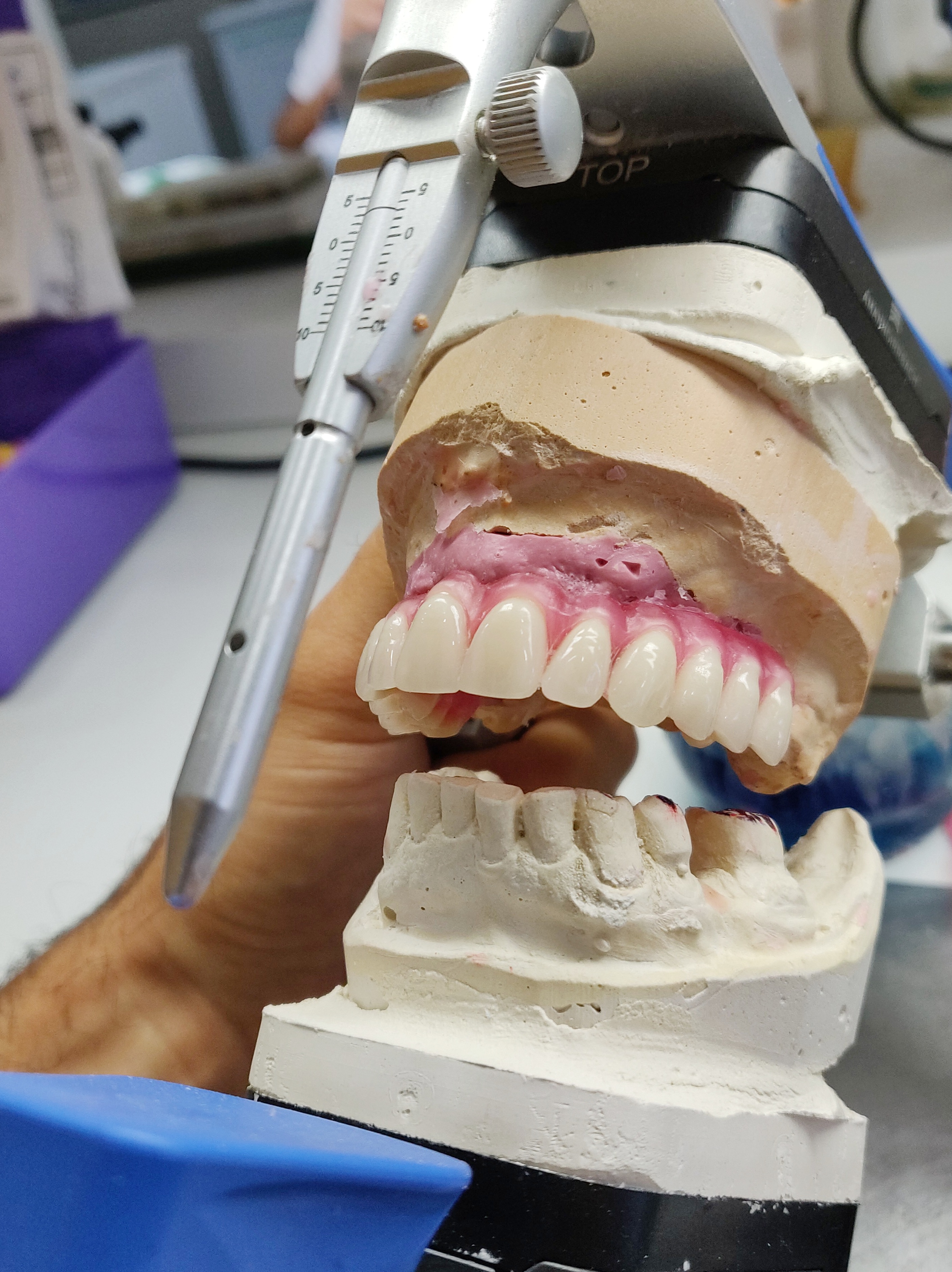 Съёмное протезирование 